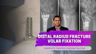 Distal Radius Fracture  Volar Fixation [upl. by Udenihc]