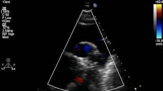 Patent Ductus Arteriosus [upl. by Repip162]