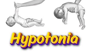 Hypotonia Symptoms Causes and Treatment [upl. by Meave]