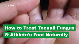 How to Treat Toenail Fungus amp Athletes Foot Naturally [upl. by Dessma]