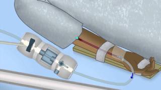 Interpreting Arterial Pressure Waveforms by J DiNardo  OPENPediatrics [upl. by Mauro102]