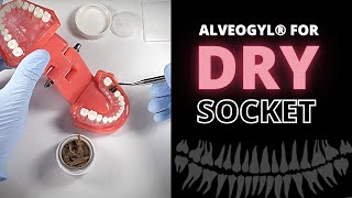 Using Alveogyl To Relieve Dry Socket Pain Alveolar Osteitis  OnlineExodontiacom [upl. by Ahtnams285]