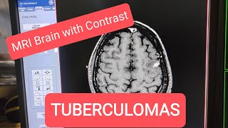 Brain MRI with Contrast Tuberculoma [upl. by Iralav]