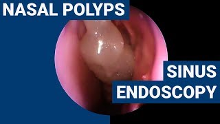 Nasal polyps  PHACON Sinus Patient Meyer [upl. by Lanti21]