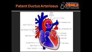 Patent Ductus Arteriosus [upl. by Diet998]