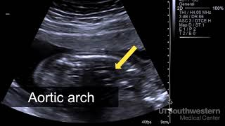 Endometrial Cancer  Did You Know [upl. by Hagood]