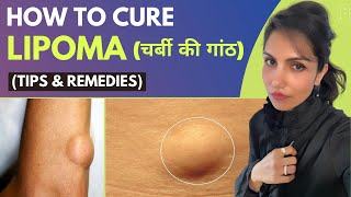 How To Cure Lipoma Naturally चर्बी की गांठ [upl. by Eirrahs]