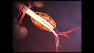 Cirurgia Endovascular de Aneurisma da Aorta Abdominal [upl. by Rustin]