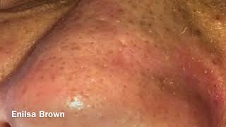 Blackheads Extractions and Acne Treatment on Daryl [upl. by Holcomb]