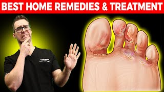 Athletes Foot Fungus BEST Home Remedies amp Treatment [upl. by Monia699]